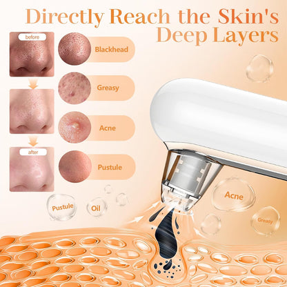 Aspirateur de Points Noirs Professionnel - heuremarket